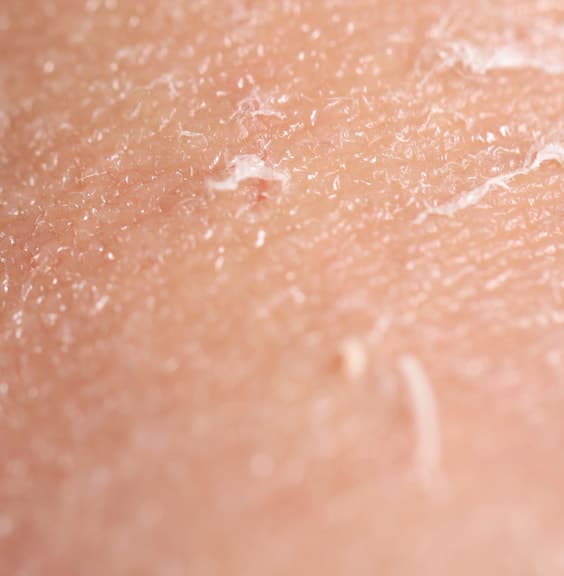 Close-up of dry skin with fine flakes