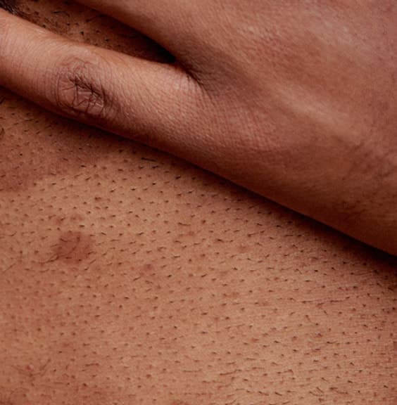 Skin with patchy, uneven tone