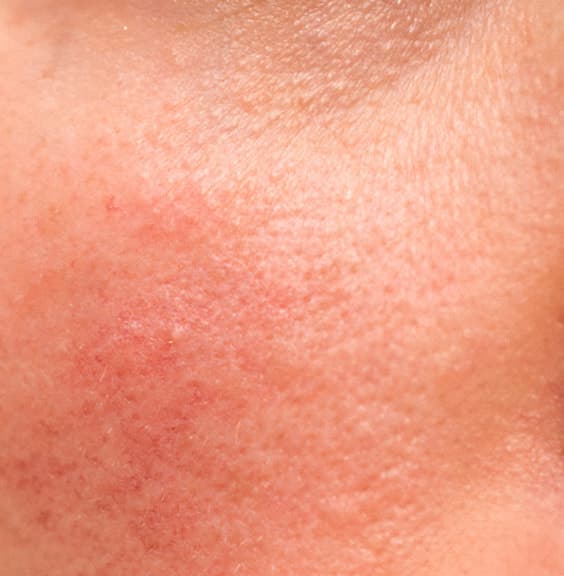 Close-up of red, irritated cheek skin