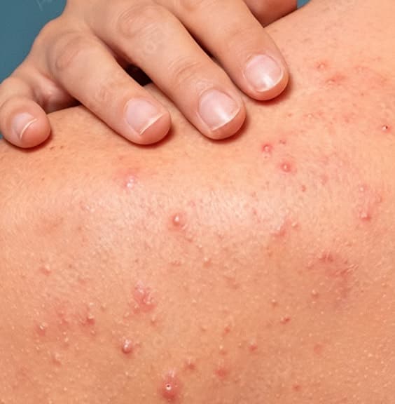 Small clustered bumps across the shoulder