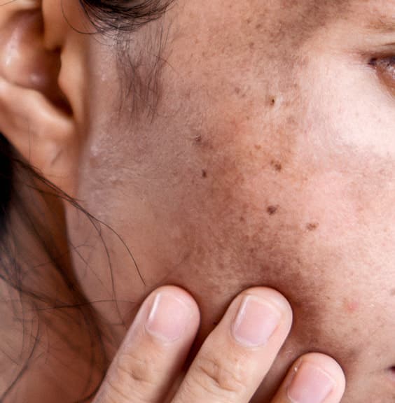 Cheek with dark spots and uneven pigment