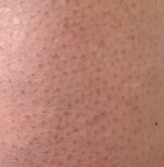 Close-up of small rough bumps on the upper arm